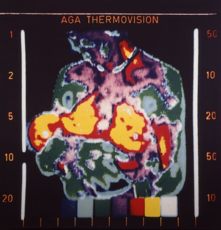 Thermographies