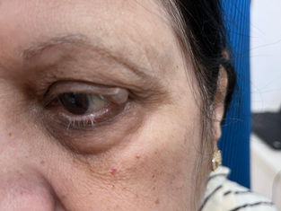 Understanding Ocular Cancer