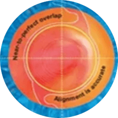 cataract-step3.png
