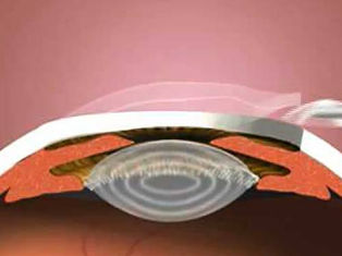 Phakic Iol/icl- When Laser Is Not an Option!