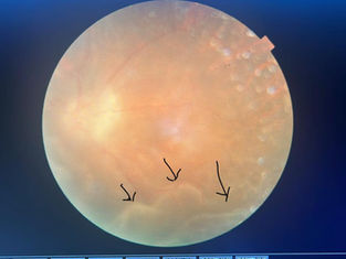 Warning Signs & Symptoms of Retinal Detachment You Shouldn’t Ignore