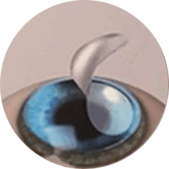 LASIK.png