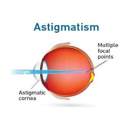 Astigmatism.jpg