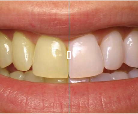 blanqueamiento dental