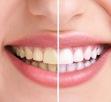 Professional Teeth Whitening in Thane _ Creative Smiles Dental Clinic.jpeg