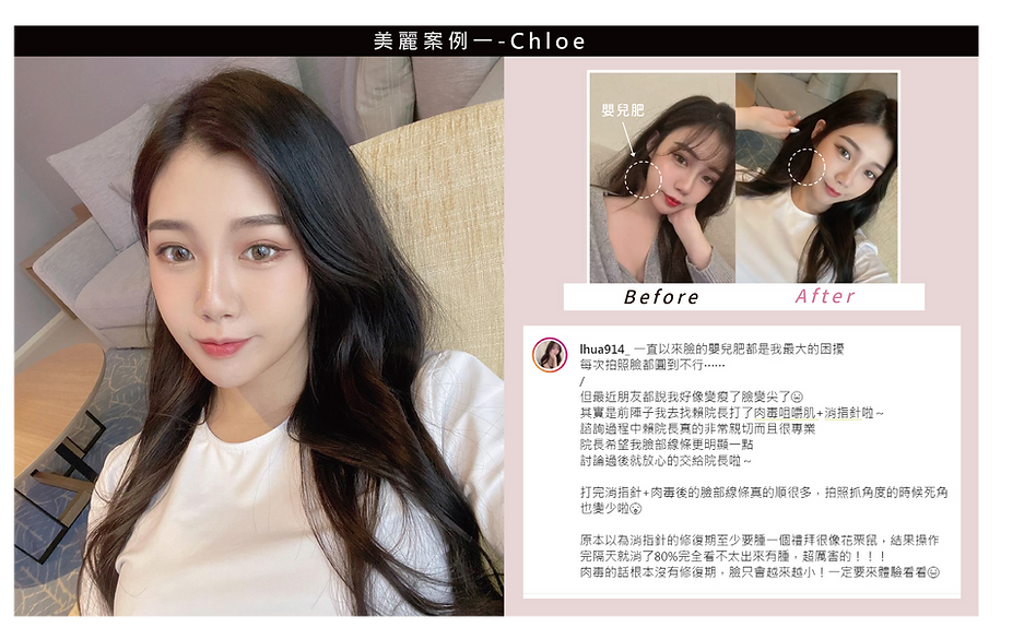 肉毒 瘦小臉 瘦小腿 除皺 彰化 中部 醫美 推薦 整形 整形外科 整外