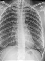 Radiografia de Torax Frente.jpeg