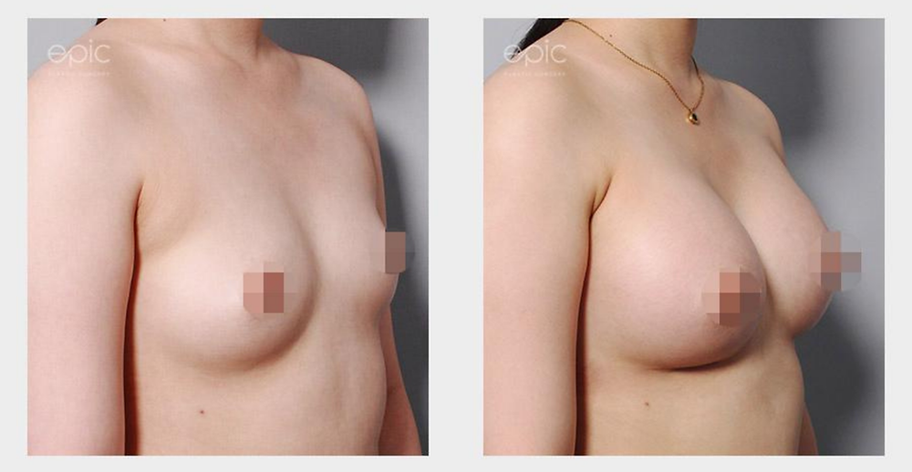 รีวิวเสริมหน้าอก สวยเป๊ะ ปัง! เปลี่ยนลุคให้มั่นใจ สไตล์ EPIC