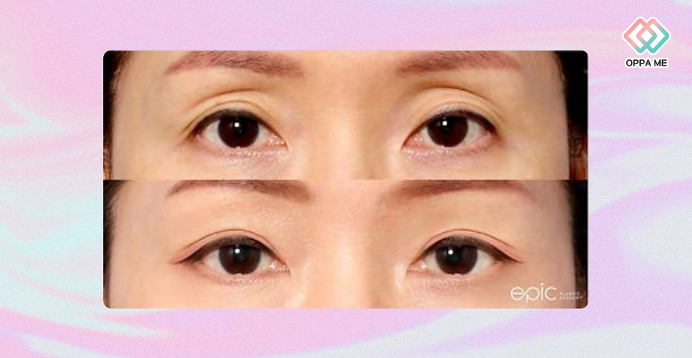 รีวิวศัลยกรรมตาสองชั้น ดวงตาสวยใสสไตล์ EPIC