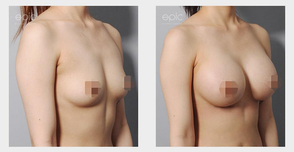 รีวิวเสริมหน้าอก สวยเป๊ะ ปัง! เปลี่ยนลุคให้มั่นใจ สไตล์ EPIC