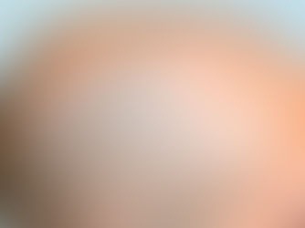 Understanding Scalp Micro Pigmentation: A Solution for Hair Loss