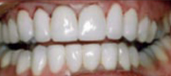 Veneers 3