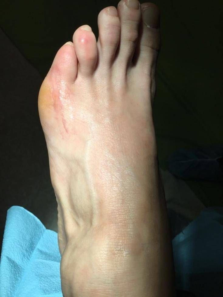 3 weeks after surgery