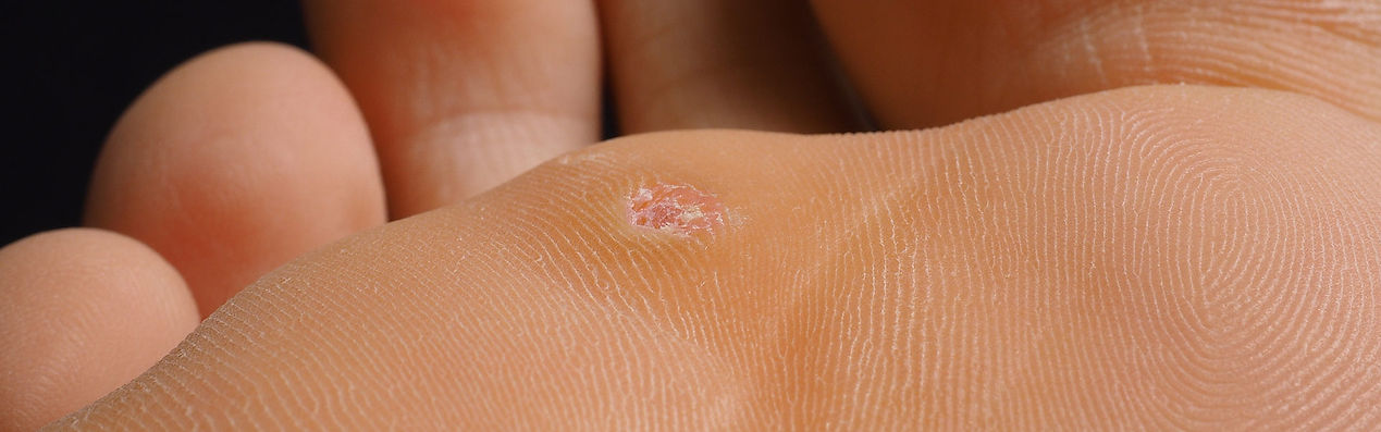 Treat Corns and Callouses in St. Catharines Today