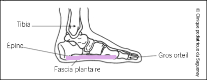 Fasciite plantaire