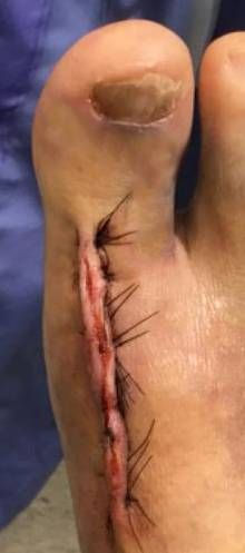 CYST excision postoperative