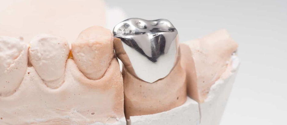 What Is a Dental Crown and Why Get a Dental Crown in London?
