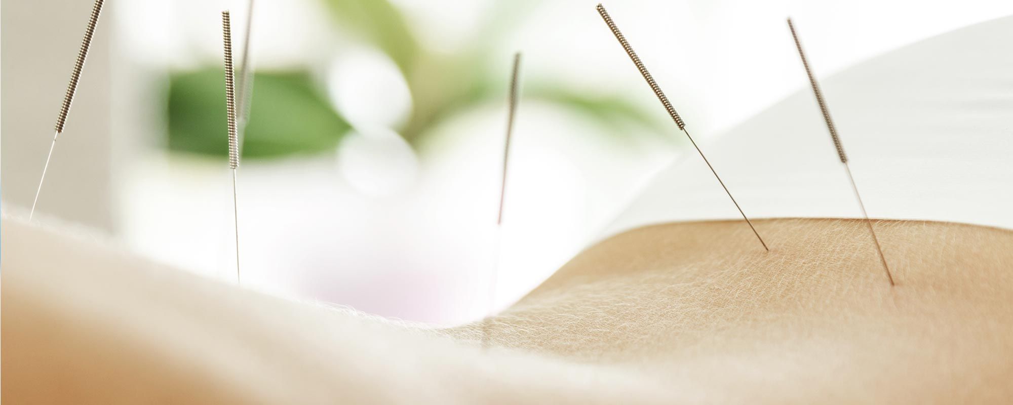 Acupuncture Treatment Calgary Acupuncture Associate Chiropractic Clinic