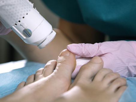 Best Toenail Fungus Treatment: Laser Therapy