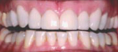 Veneers 1