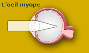 Traitement de la myopie