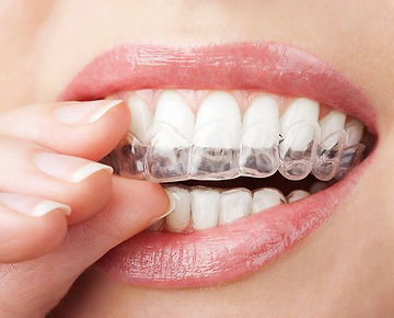 Teeth whitening mouth tray