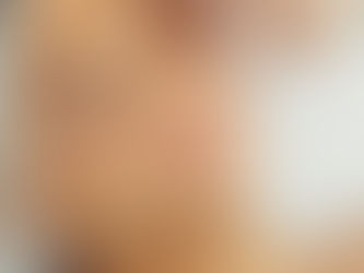 What to know before lip filler?