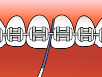 teeth with braces flossing step 1