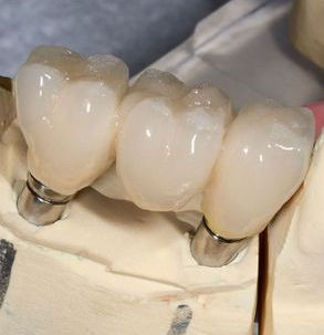 implant teeth