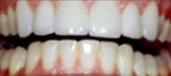 Veneers 4