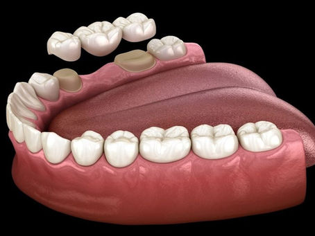 Everything You Need to Know About Dental Crown vs. Dental Bridge