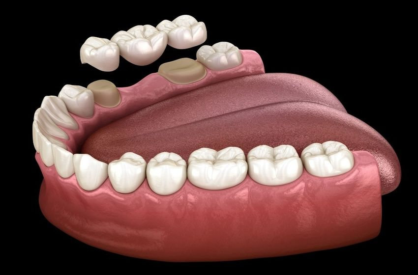 Everything You Need to Know About Dental Crown vs. Dental Bridge