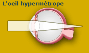 hypermétropie