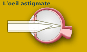 Correction de l’astigmatisme