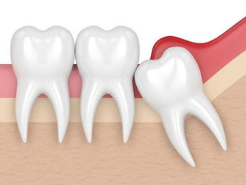Impacted Wisdom Teeth: Signs & Treatment
