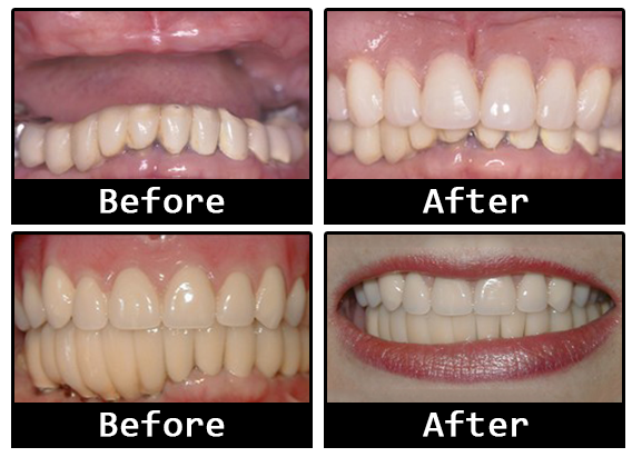 Dental Implant