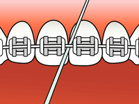 teeth with braces flossing step 2