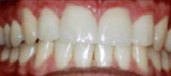 Veneers 2