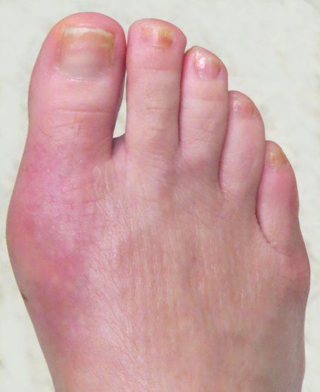 4 weeks after recovery from surgery