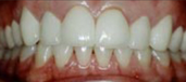 Veneers 5