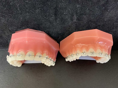 clear braces