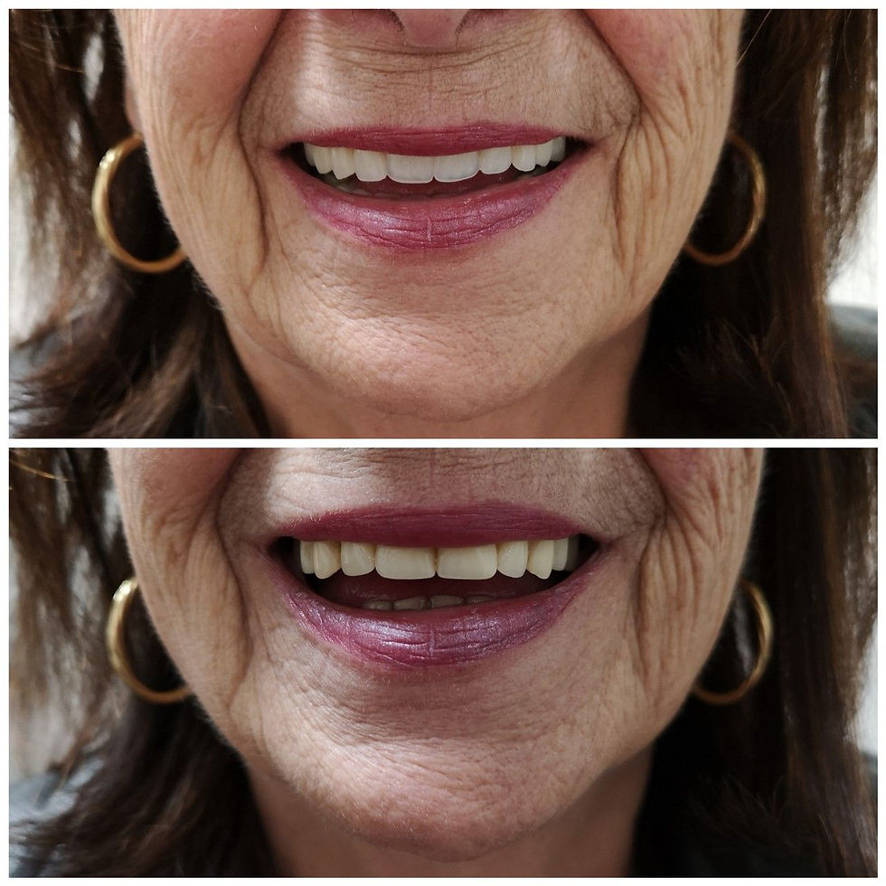 Before and after dentures