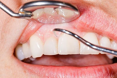 Healthy gums