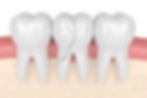 a view of crooked dental tooth