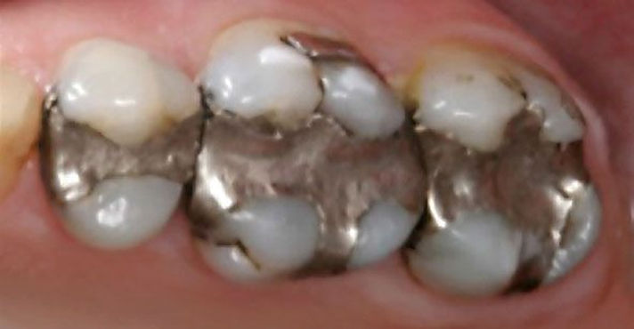 Avant le traitement CEREC 3D - restauration dentaire Clinique Bois-Francs