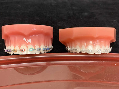 metal braces