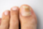 Ingrown nail