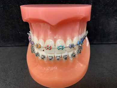 metal colored braces