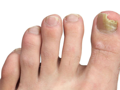 Facts About Toenail Fungus and Treatment Options