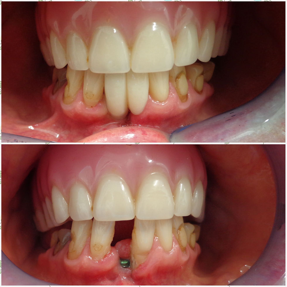 Before and after implant procedure